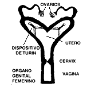 DIU Bovino - Detalhes